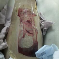 Skin Graft Donor Site