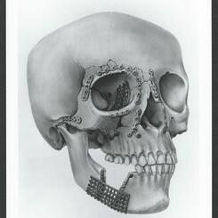 Plating of facial fractures