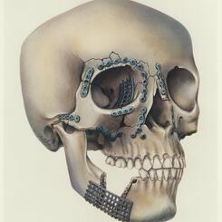 Plating of facial fractures
