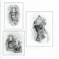 Transpalatal Approach to the Nasopharynx