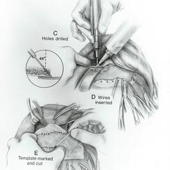 Surgical repair of fractured frontal bone of forehead