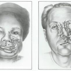 Gun shot wounds to the face