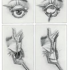 Surgical repair of dog bite to eyelid