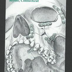 Fracture repair of the maxilla and zygoma