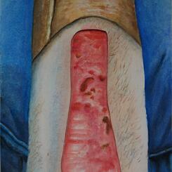 Skin Graft Donor Site