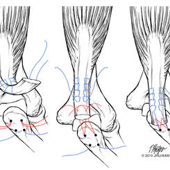 Triceps Muscle Repair