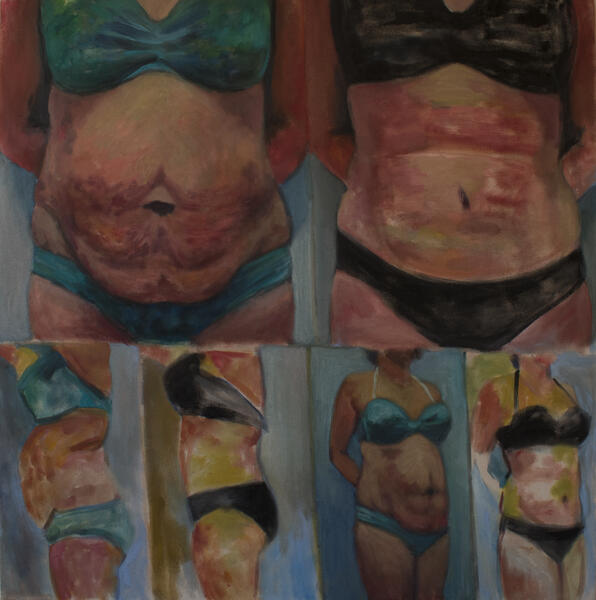 Before and After Tummy Tuck 